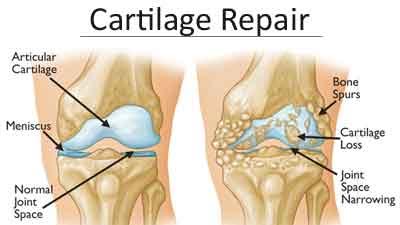 Cartilage repair treatment may prevent joint replacement : Study