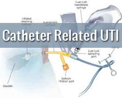 Prevention of Catheter Associated UTI in Hospitals - Guidelines