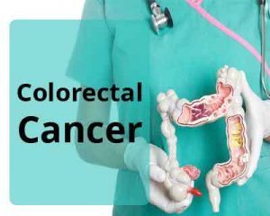 Colorectal cancer screening guidelines by American College of Physicians