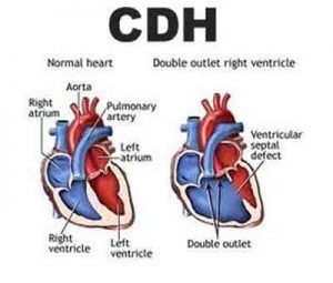 Folic acid fortified food linked to decline in CDH : AHA Study