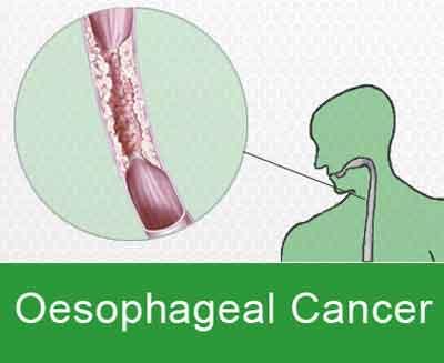 Born to be benign cells could help in identifying oesophageal cancer at early stage