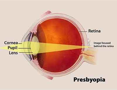 Mobile phones causing presbyopia at an early age: Doctors