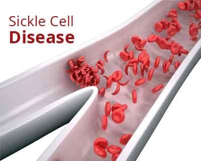 Researchers find biomarker for sickle cell disease