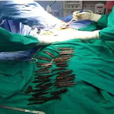 Amritsar: Doctors remove 40 knives from a mans stomach in a rare surgery