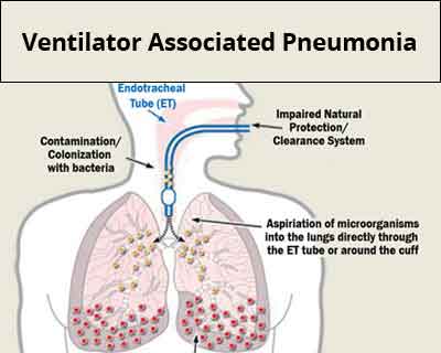 Preventing Ventilator Associated Pneumonia in hospitals - GOI Guidelines