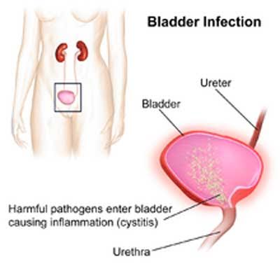 Researchers take a new step towards non-antibiotic bladder infection therapies