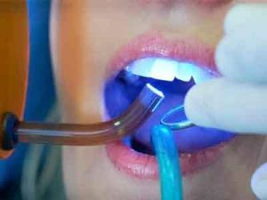 An end to cavities for people with sensitive teeth?