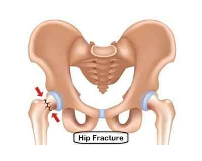 Hip fractures in the elderly lead to increased all‐cause mortality