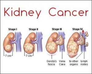 Percutaneous ablation an effective alternative to surgery in early renal cell carcinoma