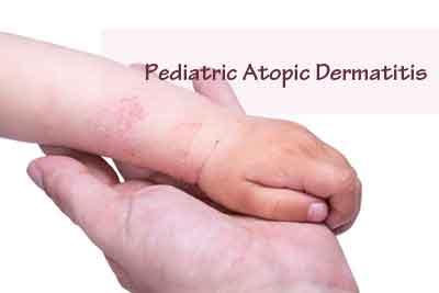 Pediatric atopic dermatitis may benefit from early immune intervention