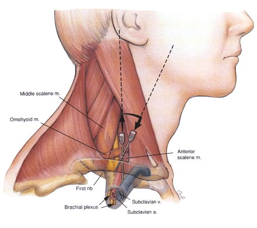 Ultrasound-guided brachial plexus block good for arteriovenous fistula creation