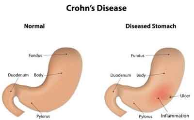 Food-poisoning bacteria responsible for Crohns disease: Study