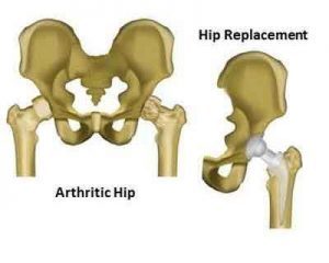 Outcomes of Hip replacement surgery different for men and women: Study