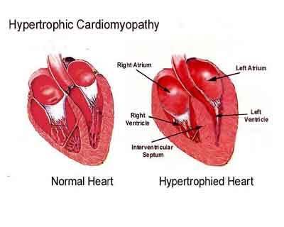 Mitraclip-Mitral valve placation for the treatment of obstructive hypertrophic cardiomyopathy