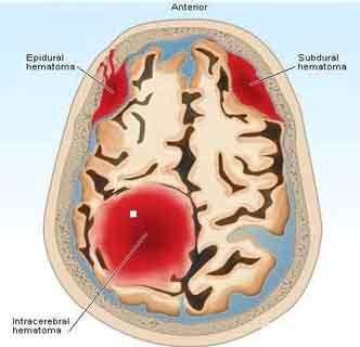 Lower doses of NOACs dont increase risk of intracranial haemorrhage : JAMA