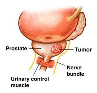 Active Surveillance of Prostrate Cancer important, says new study