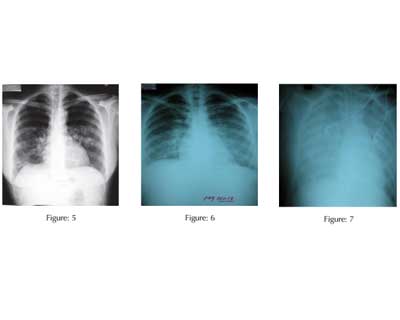 Routine X-Ray Not Needed After US-Guided Central Line Insertion