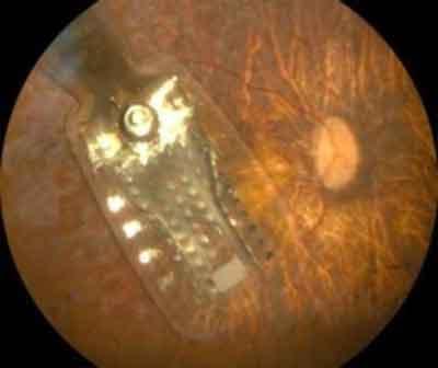 New treatment improves vision in congenital retinal blindness