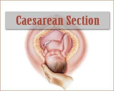Caesarean sections births altering course of evolution