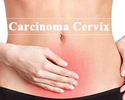 Standard Treatment Guidelines For Carcinoma Cervix