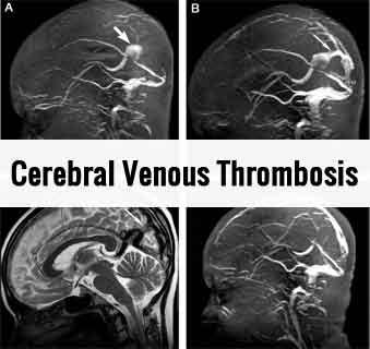Bengaluru: Patient recovers successfully after being operated for Cerebral Venous Thrombosis