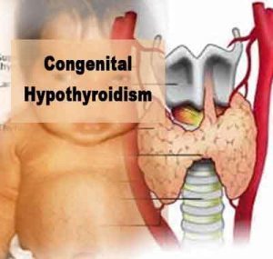 Congenital Hypothyroidism scan vital to avoid mental damage in new borns