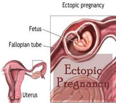 C- section scar ectopic pregnancy- a case report