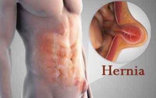 Inguinal Hernia in men associated with increase in estrogen