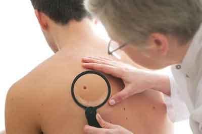 Higher serum Vitamin D associated with better outcome in melanoma, finds study