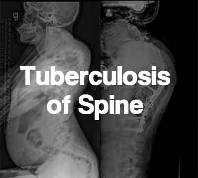 Tuberculosis of Spine- Standard Treatment Guidelines