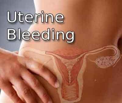 Standard Treatment Guidelines For Dysfunctional Uterine Bleeding