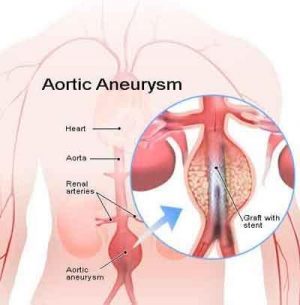 Endovascular aneurysm repair associated with higher long term mortality than open surgery: Lancet