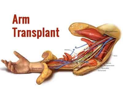 Boston hospital performs double arm transplant on Marine