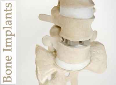 3-D printed bone implant dissolves in the body
