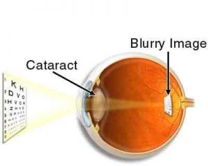 Cataract surgery in older women associated with decreased mortality