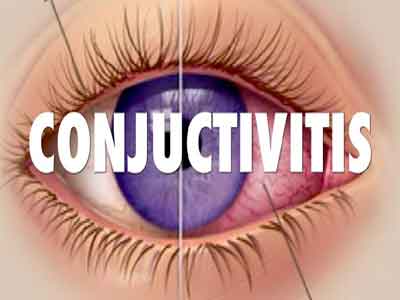 Standard Treatment Guidelines for Conjunctivitis