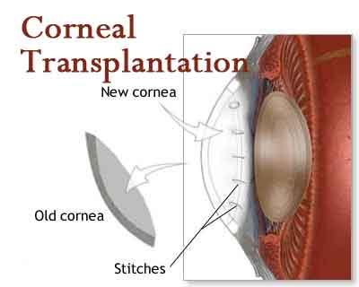 Minimally invasive corneal transplantation improves outcomes in Keratoconus  : AAO
