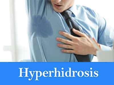 Sweat too much? You might have a treatable medical condition called hyperhidrosis