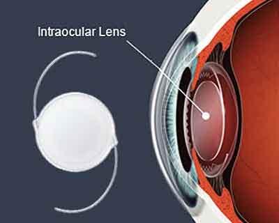 After cataract surgery, IOL implantation not recommended for children 6 months or younger