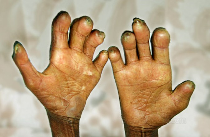 Centres Drive reveals 20,000 hidden cases of Leprosy