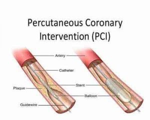 Low platelet count does not increase bleeding risk in PCI