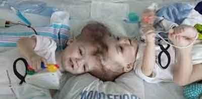 Landmark Surgery-Docs separate twins joined at the head in 20 hour operation