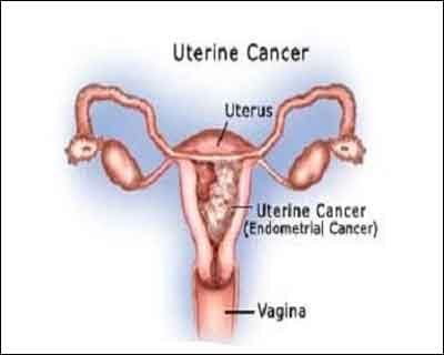 Taking Tamoxifen does not escalate risk of uterine cancer: Study