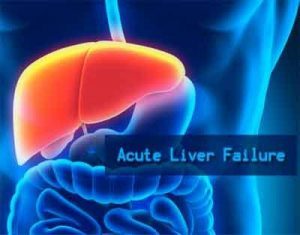 A rare case of liver failure induced by mercury exposure and acetaminophen