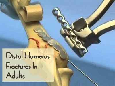 Distal Humerus Fractures In Adults - Standard Treatment Guidelines