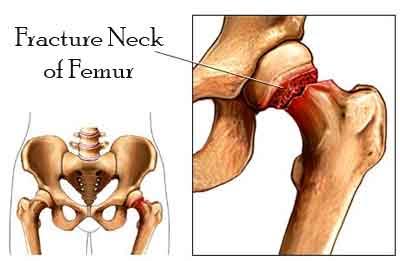 Long Limb Trauma: Fracture Neck of Femur (Intra-capsular) - Standard Treatment Guidelines
