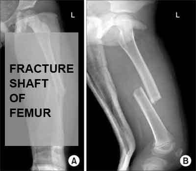 Fracture Shaft of Femur - Standard Treatment Guidelines