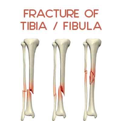fractured fibula and tibia