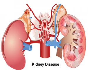 Diabetic patients with 3 risk factors at high risk of kidney disease