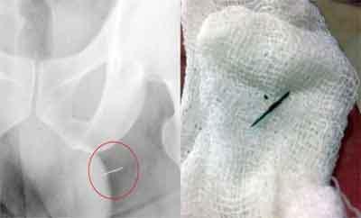 Needle Removed From Mans Body After 22 Years